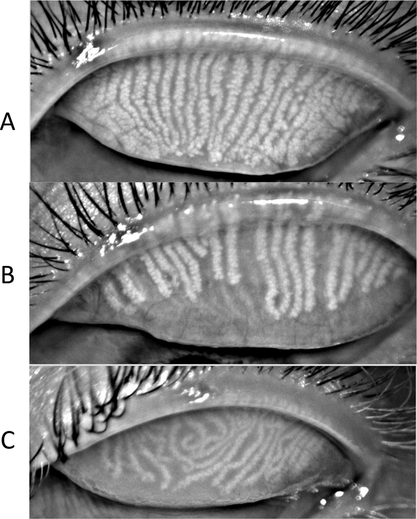 👁‍🗨 Say Goodbye to Dry Eyes with IPL Therapy